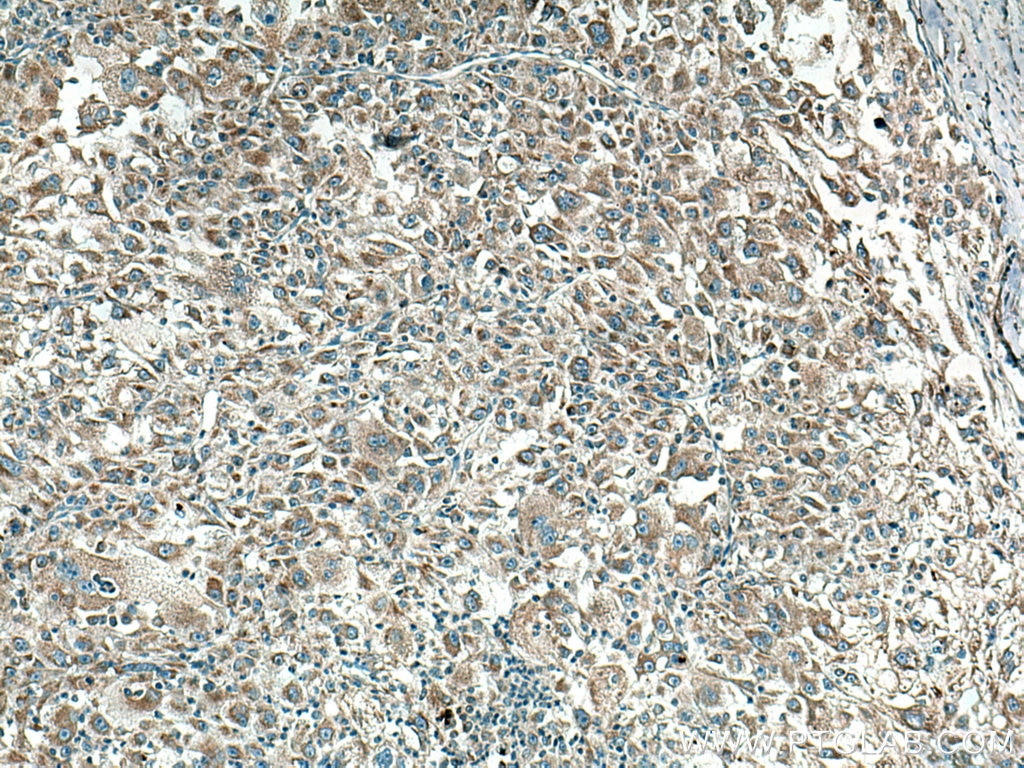 Immunohistochemistry (IHC) staining of human liver cancer tissue using CYR61 Monoclonal antibody (67656-1-Ig)