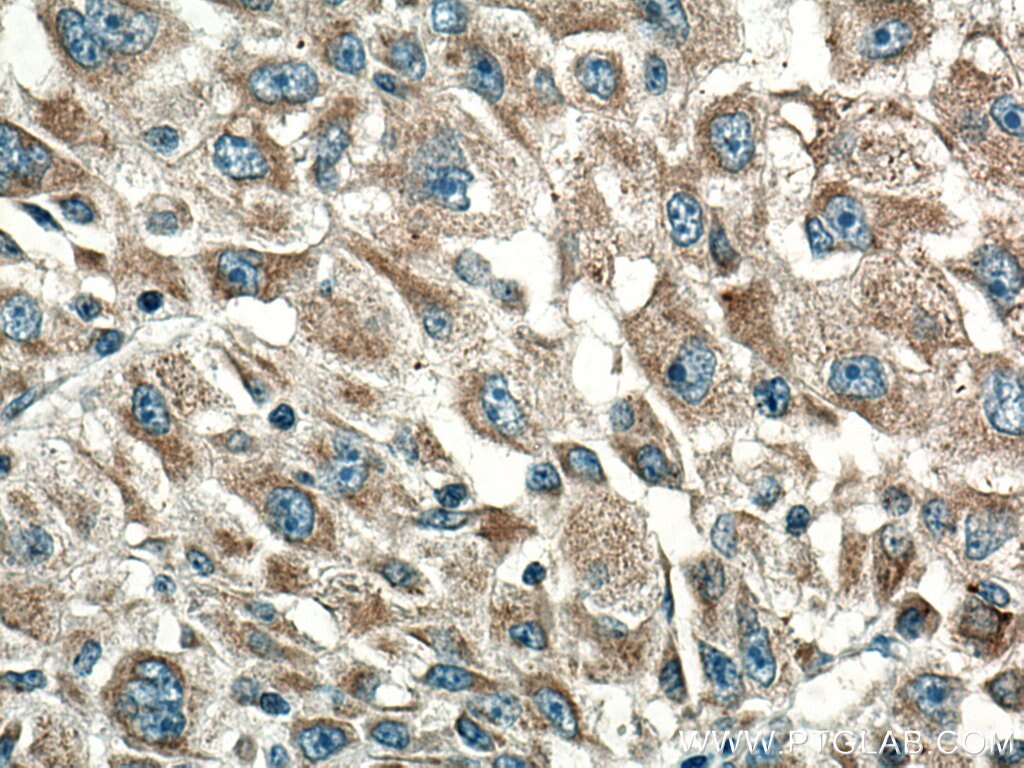 Immunohistochemistry (IHC) staining of human liver cancer tissue using CYR61 Monoclonal antibody (67656-1-Ig)