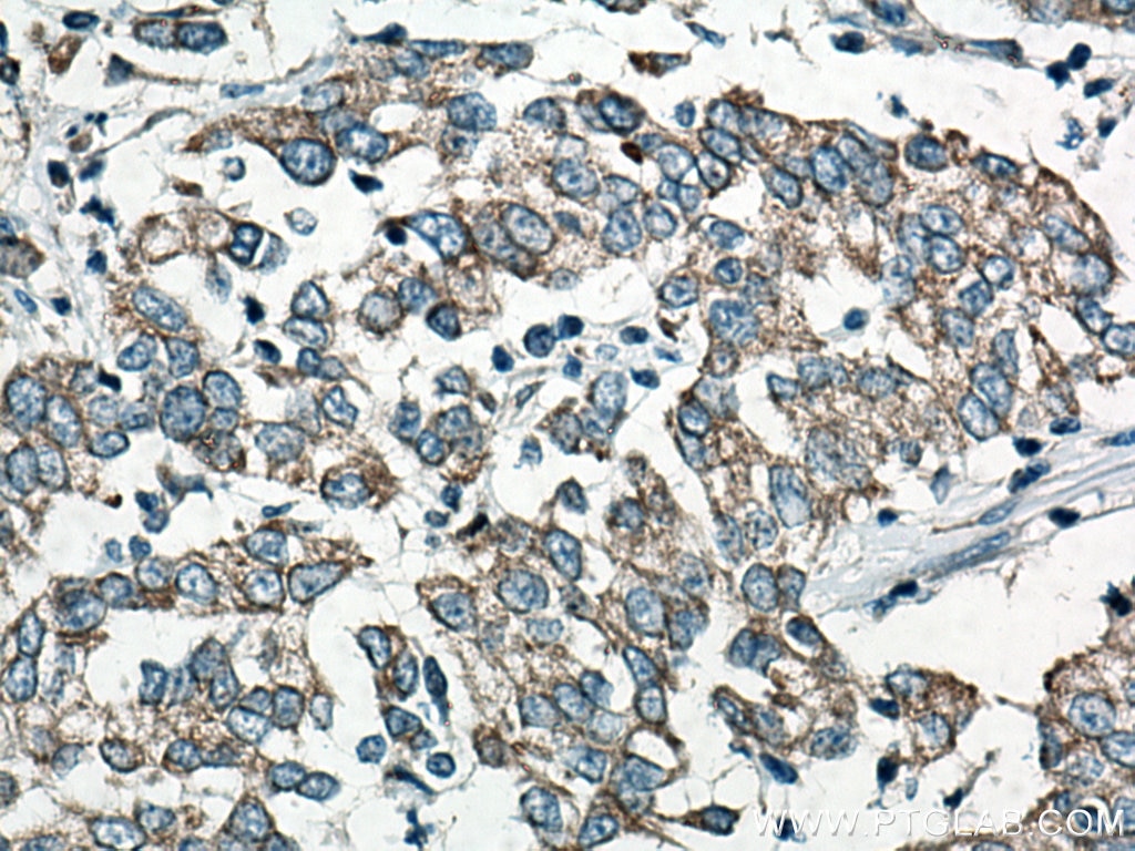 Immunohistochemistry (IHC) staining of human stomach cancer tissue using CYR61 Monoclonal antibody (67656-1-Ig)