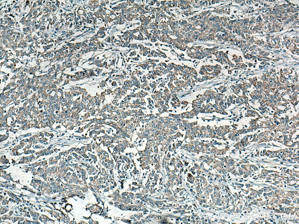 Immunohistochemistry (IHC) staining of human stomach cancer tissue using CYR61 Monoclonal antibody (67656-1-Ig)