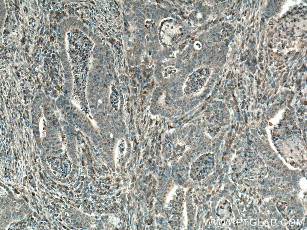 Immunohistochemistry (IHC) staining of human colon cancer tissue using CYR61/CCN1 Polyclonal antibody (26689-1-AP)