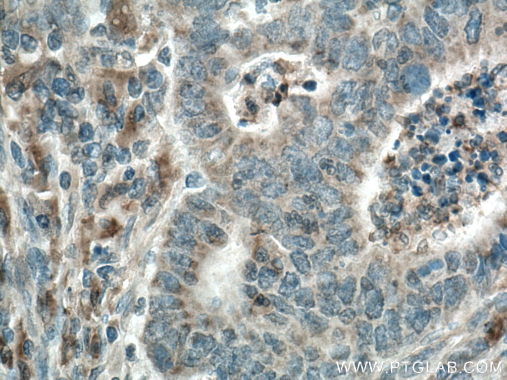Immunohistochemistry (IHC) staining of human colon cancer tissue using CYR61/CCN1 Polyclonal antibody (26689-1-AP)