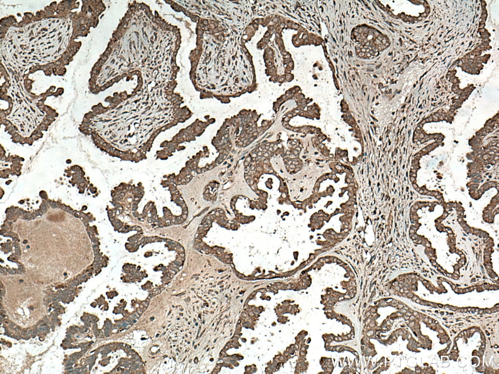 Immunohistochemistry (IHC) staining of human ovary tumor tissue using CYR61/CCN1 Polyclonal antibody (26689-1-AP)