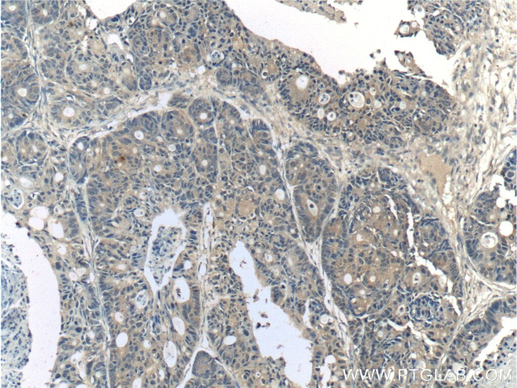 Immunohistochemistry (IHC) staining of human pancreas cancer tissue using CYS1 Polyclonal antibody (24133-1-AP)