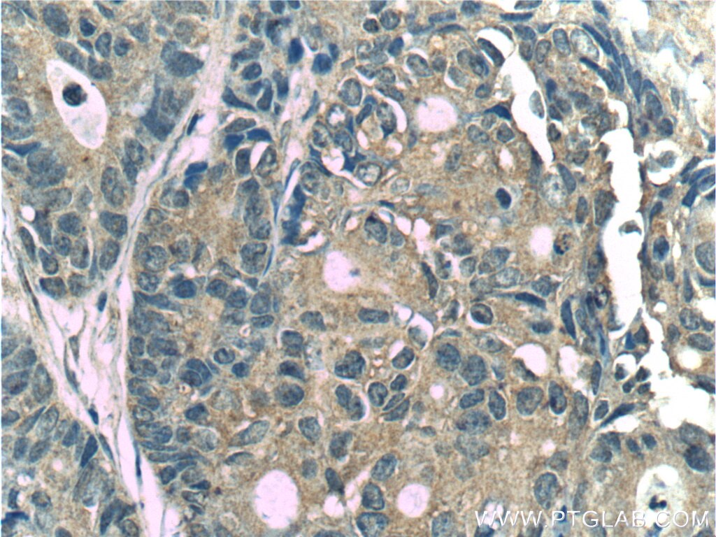 Immunohistochemistry (IHC) staining of human pancreas cancer tissue using CYS1 Polyclonal antibody (24133-1-AP)