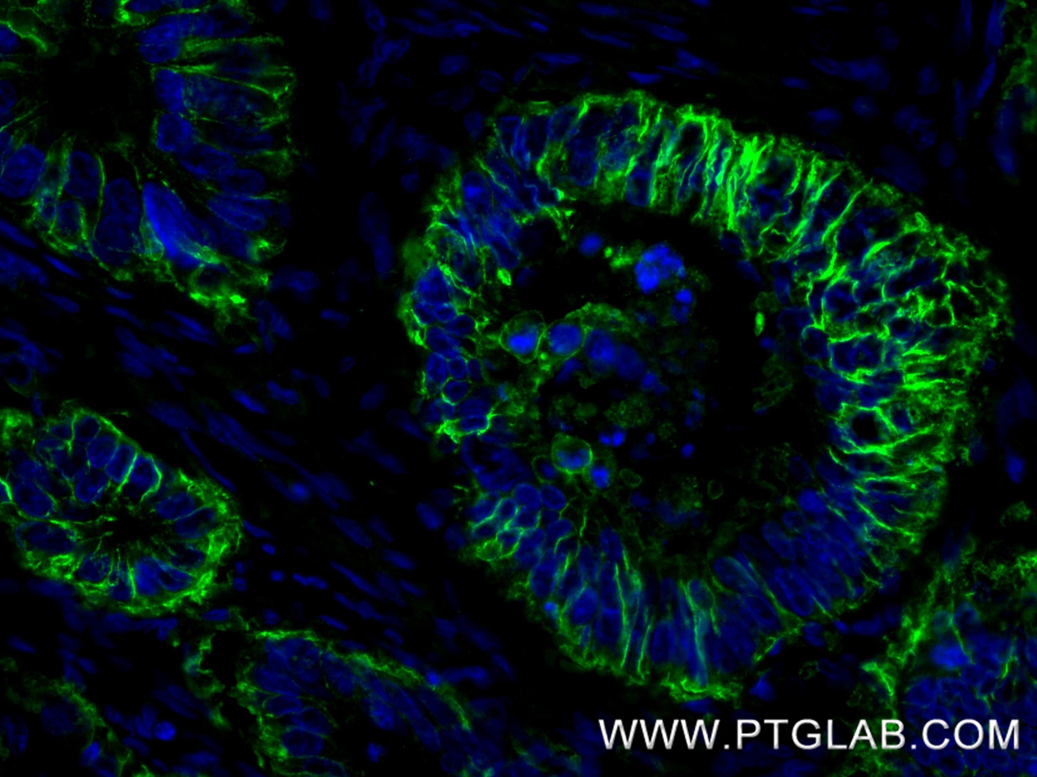Immunofluorescence (IF) / fluorescent staining of human colon cancer tissue using Cadherin-17 Recombinant monoclonal antibody (83793-5-RR)