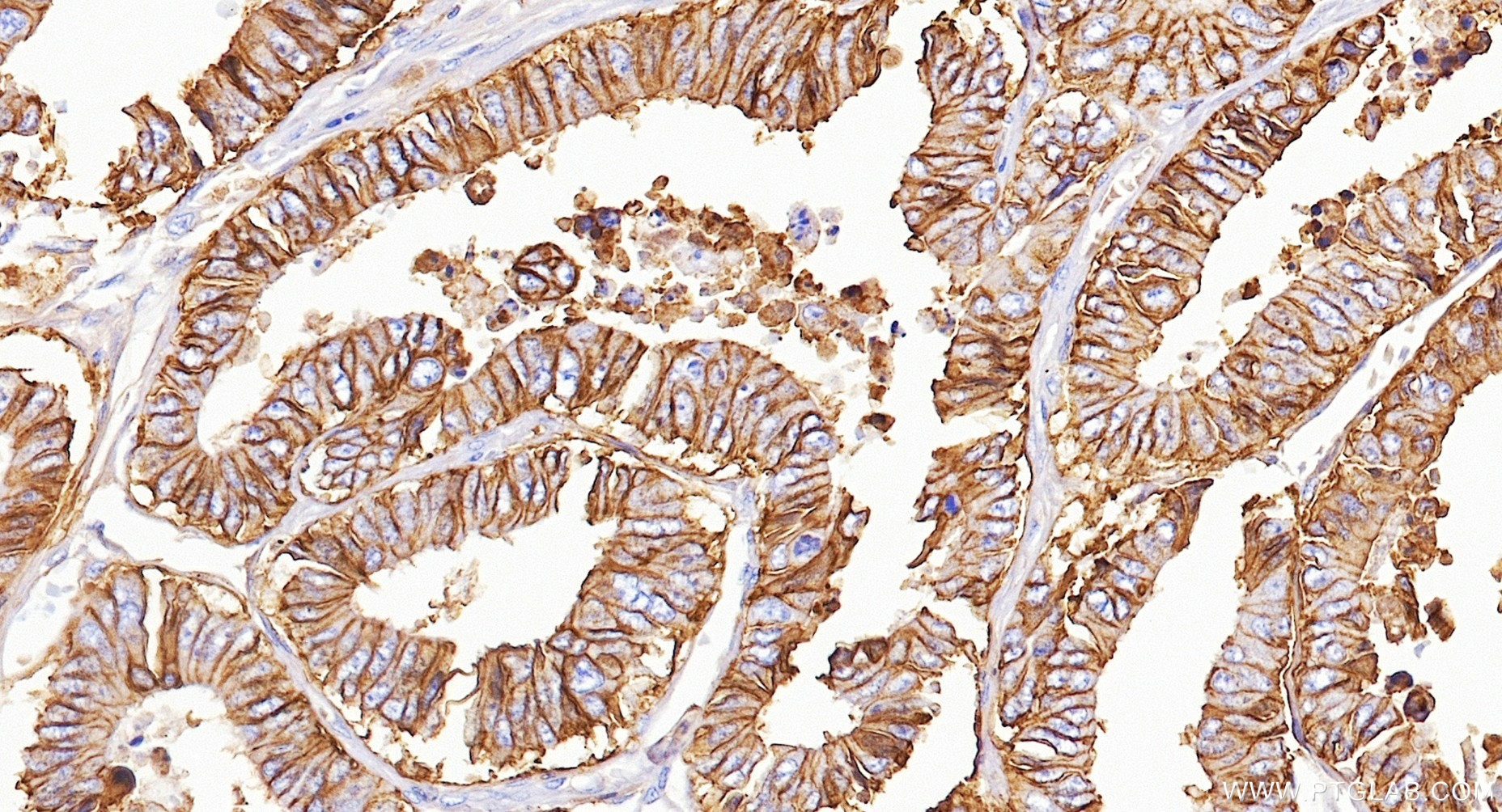 Immunohistochemistry (IHC) staining of human colon cancer tissue using Cadherin-17 Recombinant monoclonal antibody (83793-5-RR)