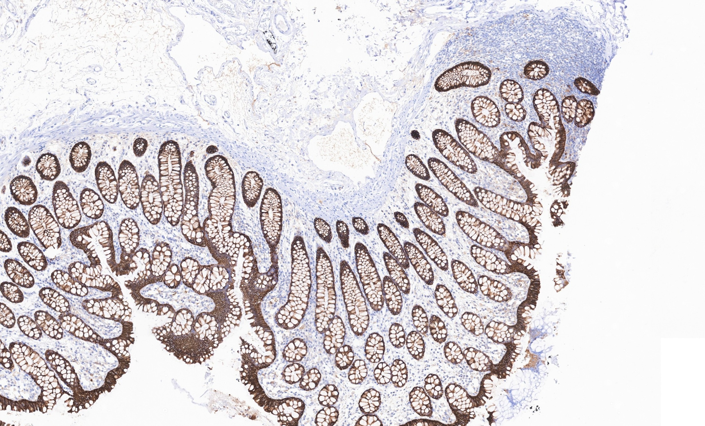 IHC staining of human large intestine using 83793-5-RR Immunohistochemistry (IHC) staining of human large intestine tissue using Cadherin-17 Recombinant monoclonal antibody (83793-5-RR)