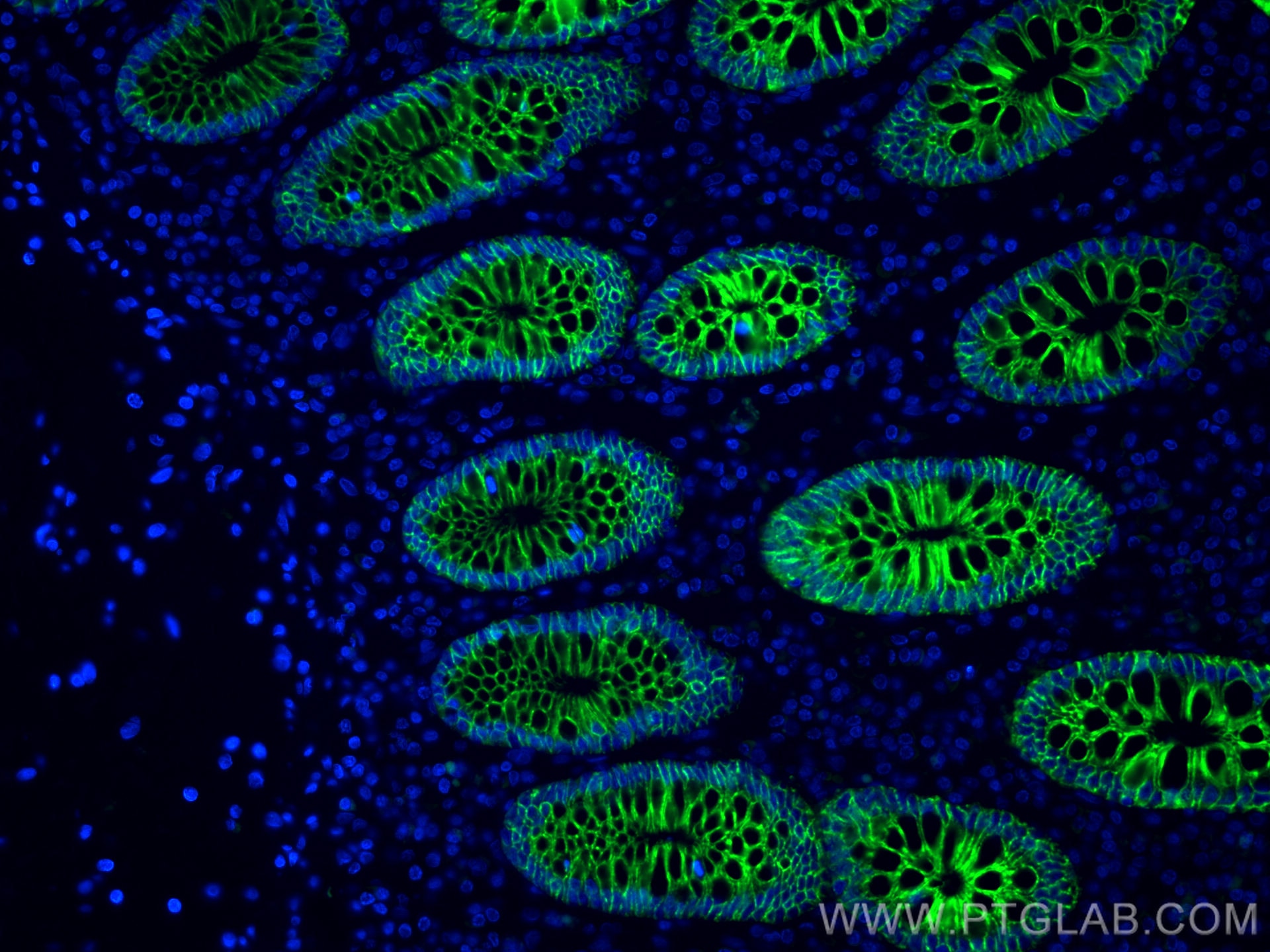 Immunofluorescence (IF) / fluorescent staining of human colon cancer tissue using CoraLite® Plus 488-conjugated Cadherin-17 Monoclon (CL488-60351)