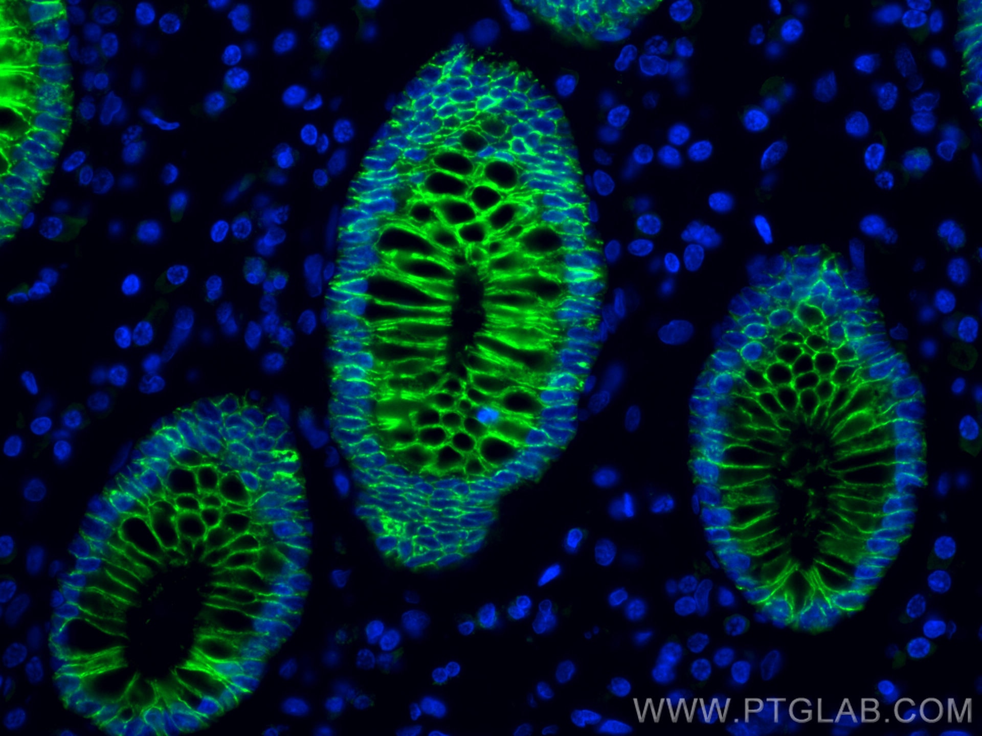 Immunofluorescence (IF) / fluorescent staining of human colon cancer tissue using CoraLite® Plus 488-conjugated Cadherin-17 Monoclon (CL488-60351)