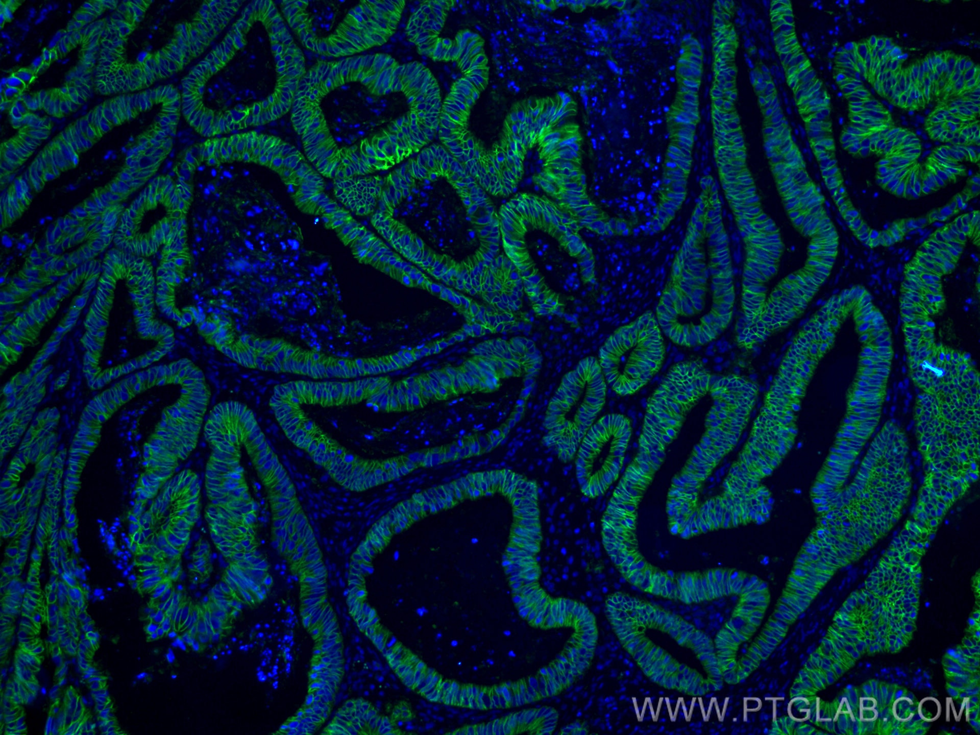 Immunofluorescence (IF) / fluorescent staining of human colon cancer tissue using CoraLite® Plus 488-conjugated Cadherin-17 Monoclon (CL488-60351)