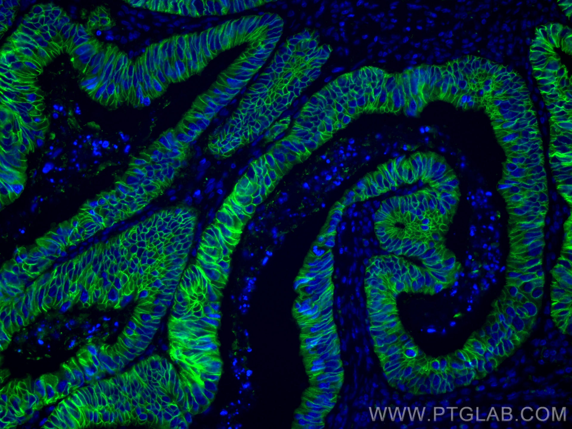 Immunofluorescence (IF) / fluorescent staining of human colon cancer tissue using CoraLite® Plus 488-conjugated Cadherin-17 Monoclon (CL488-60351)