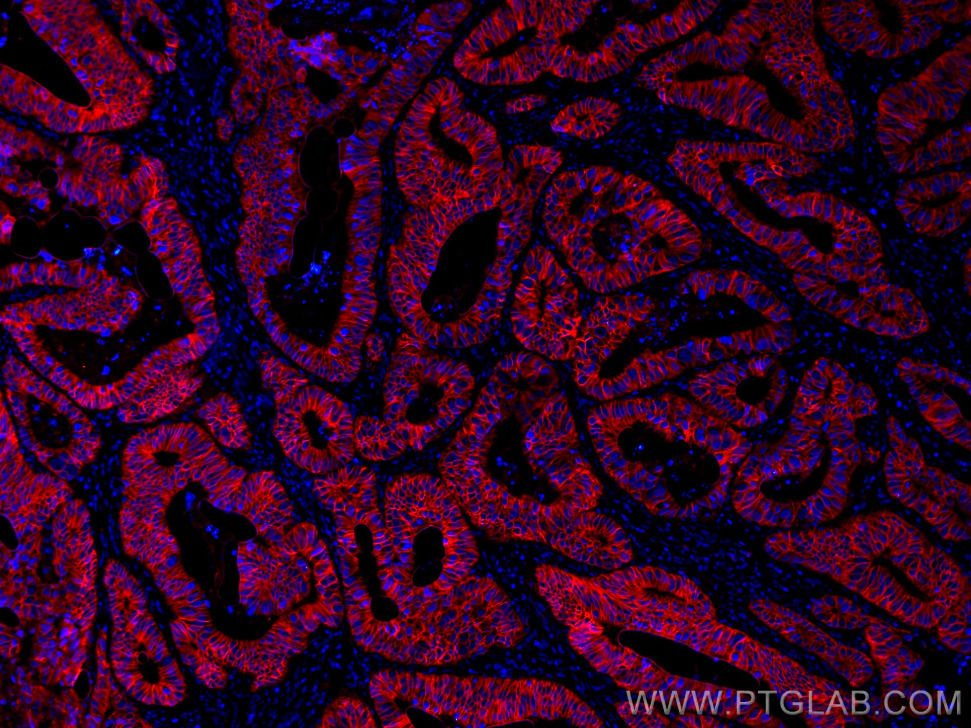 Immunofluorescence (IF) / fluorescent staining of human colon cancer tissue using CoraLite®594-conjugated Cadherin-17 Monoclonal ant (CL594-60351)