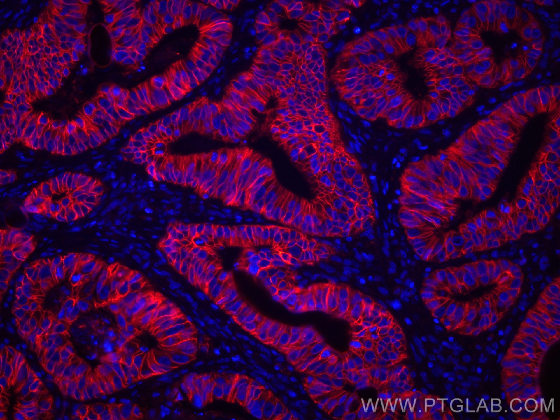 Immunofluorescence (IF) / fluorescent staining of human colon cancer tissue using CoraLite®594-conjugated Cadherin-17 Monoclonal ant (CL594-60351)