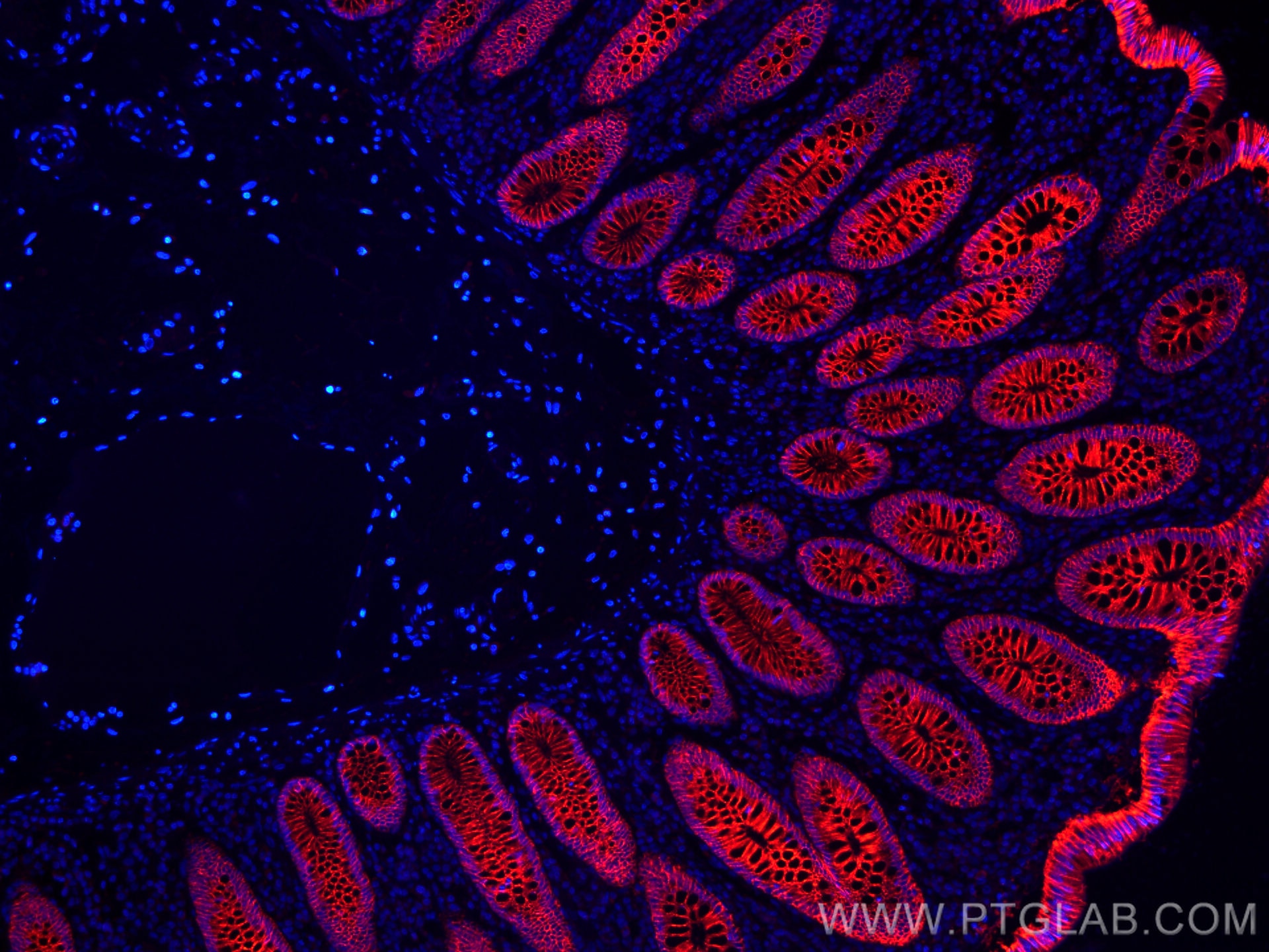 Immunofluorescence (IF) / fluorescent staining of human colon cancer tissue using CoraLite®594-conjugated Cadherin-17 Monoclonal ant (CL594-60351)