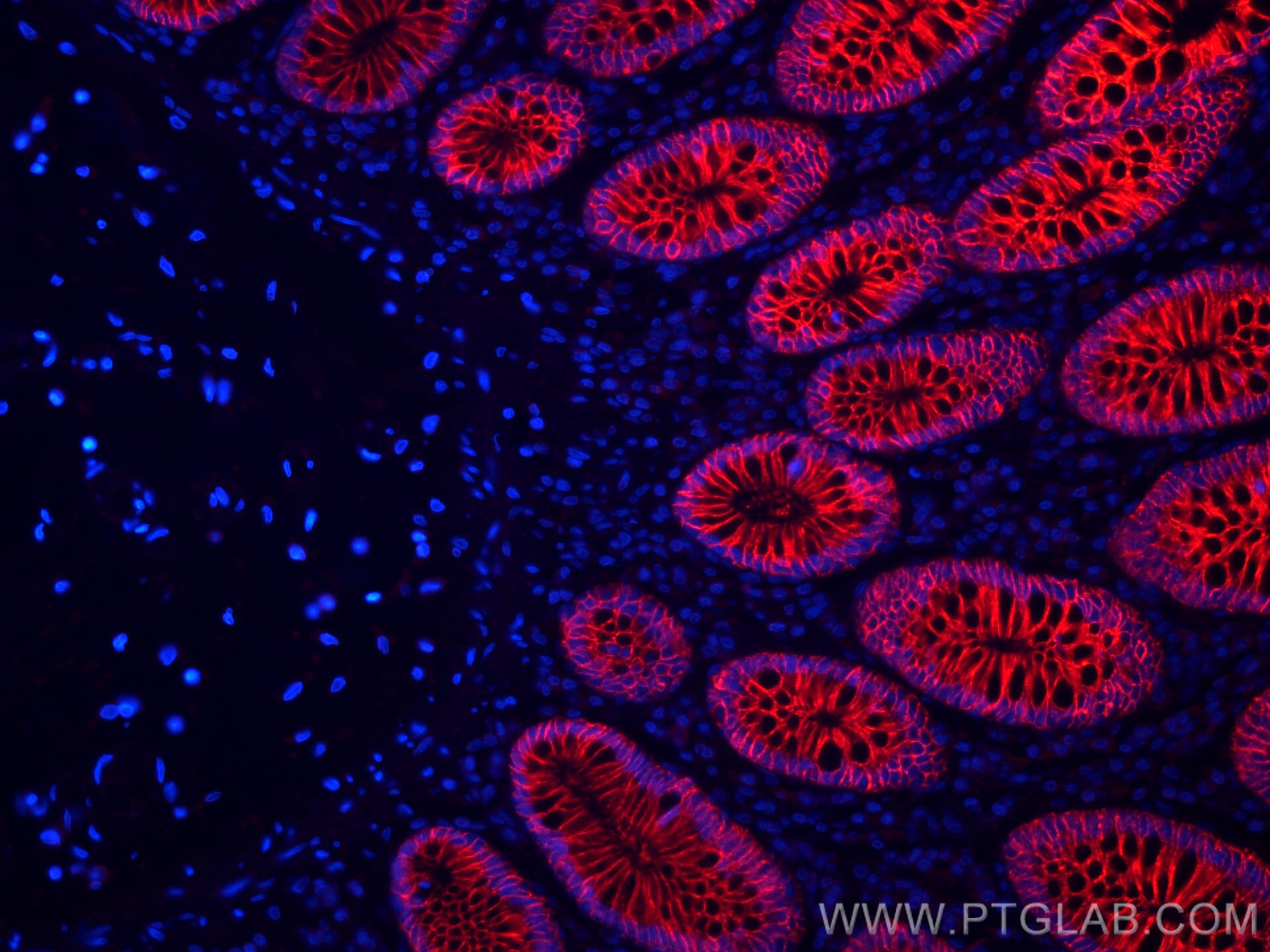 Immunofluorescence (IF) / fluorescent staining of human colon cancer tissue using CoraLite®594-conjugated Cadherin-17 Monoclonal ant (CL594-60351)