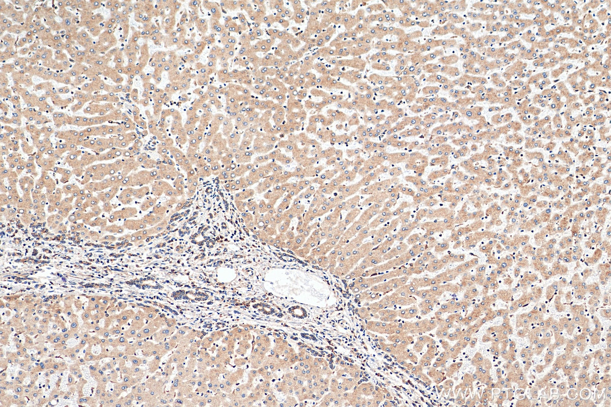 Immunohistochemistry (IHC) staining of human hepatocirrhosis tissue using Calnexin Monoclonal antibody (66903-1-Ig)