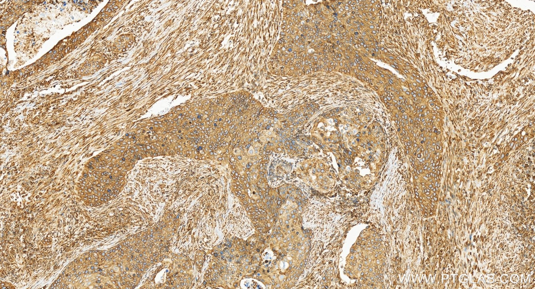 Immunohistochemistry (IHC) staining of human cervical cancer tissue using Calnexin Recombinant antibody (81938-1-RR)