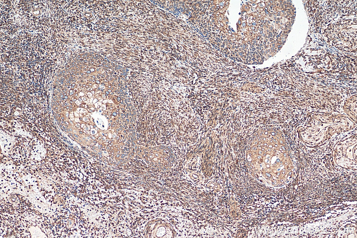 Immunohistochemistry (IHC) staining of human cervical cancer tissue using Calnexin Recombinant antibody (81938-1-RR)