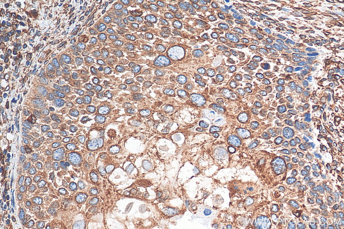 Immunohistochemistry (IHC) staining of human cervical cancer tissue using Calnexin Recombinant antibody (81938-1-RR)