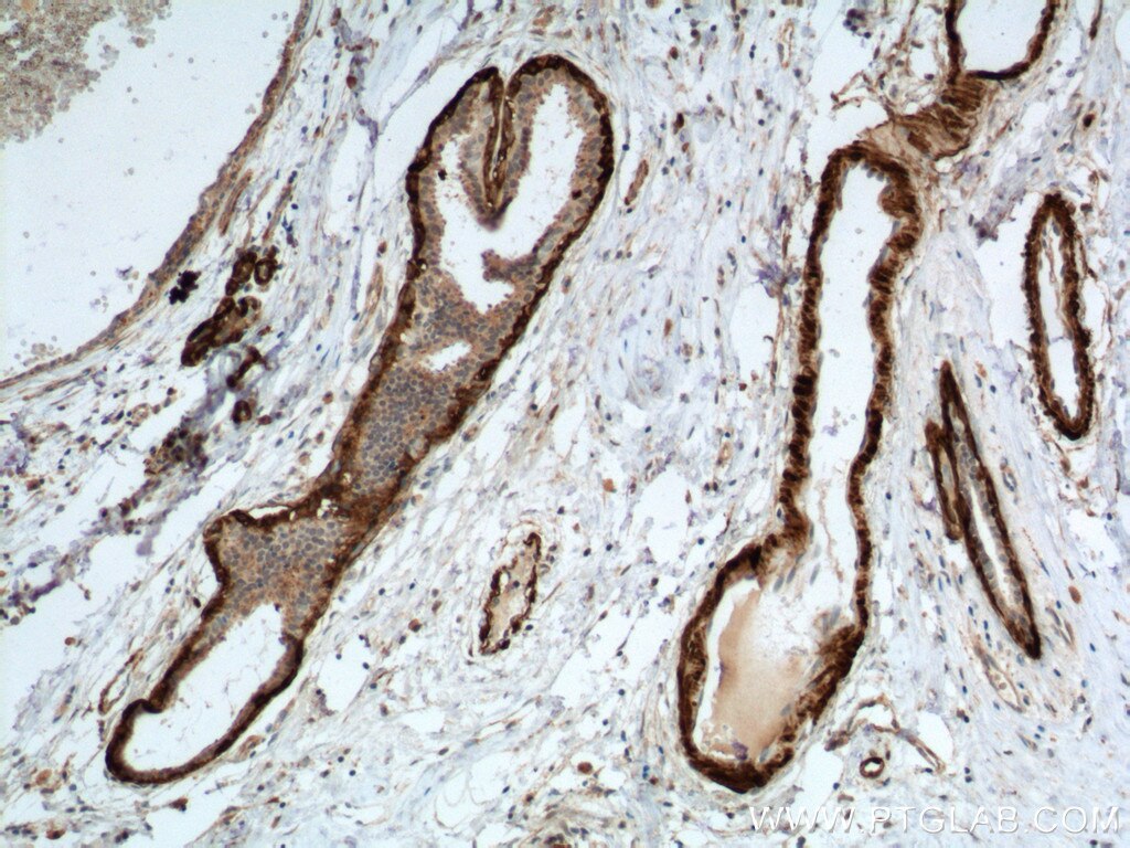 IHC staining of human breast hyperplasia using 24855-1-AP