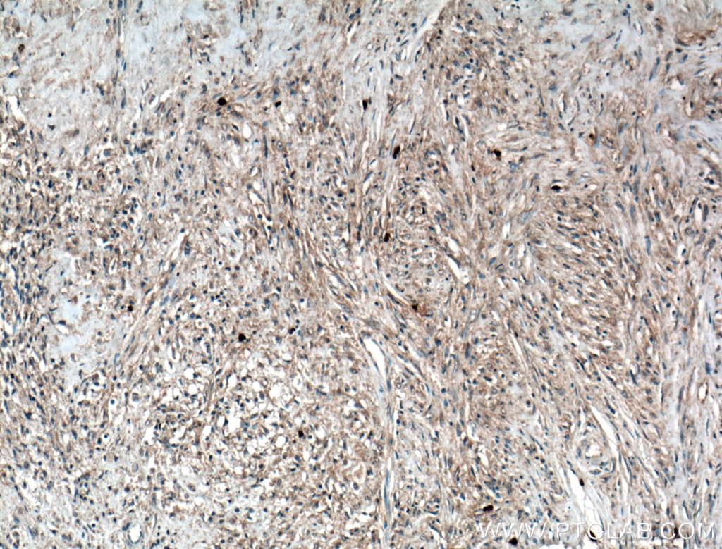 Immunohistochemistry (IHC) staining of human myofibroblastoma tissue using Calponin Monoclonal antibody (66540-1-Ig)