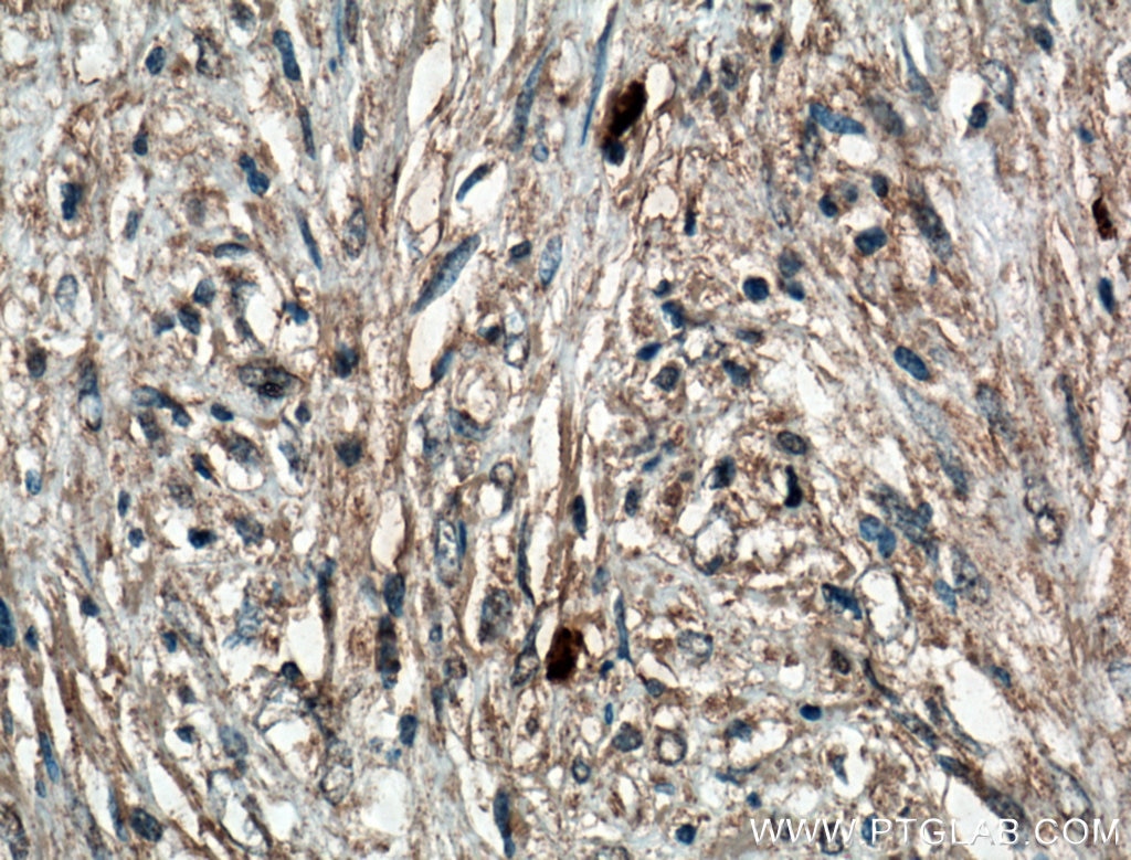 Immunohistochemistry (IHC) staining of human myofibroblastoma tissue using Calponin Monoclonal antibody (66540-1-Ig)