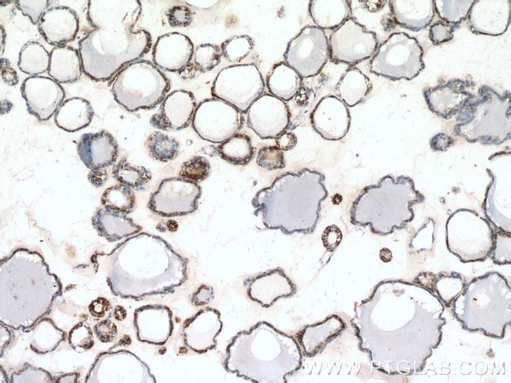 Immunohistochemistry (IHC) staining of human thyroid tissue using calreticulin Polyclonal antibody (27298-1-AP)
