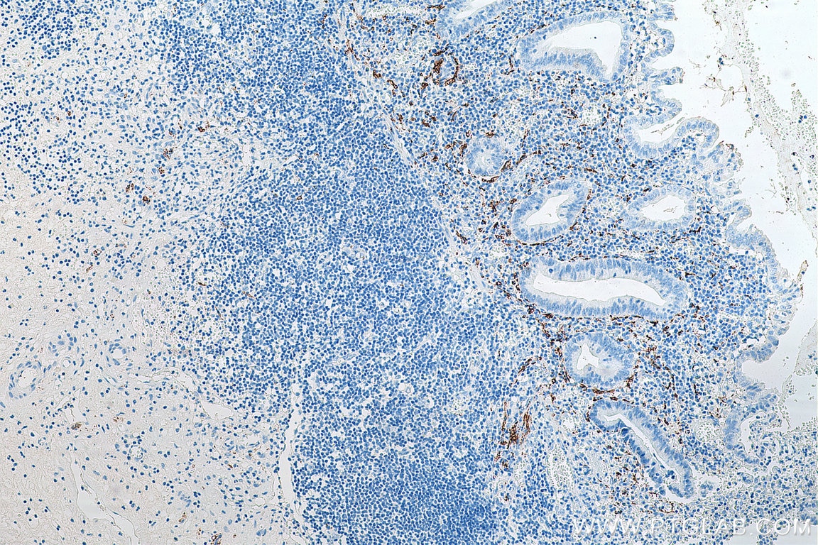 Immunohistochemistry (IHC) staining of human appendicitis tissue using Calretinin Monoclonal antibody (66496-1-Ig)