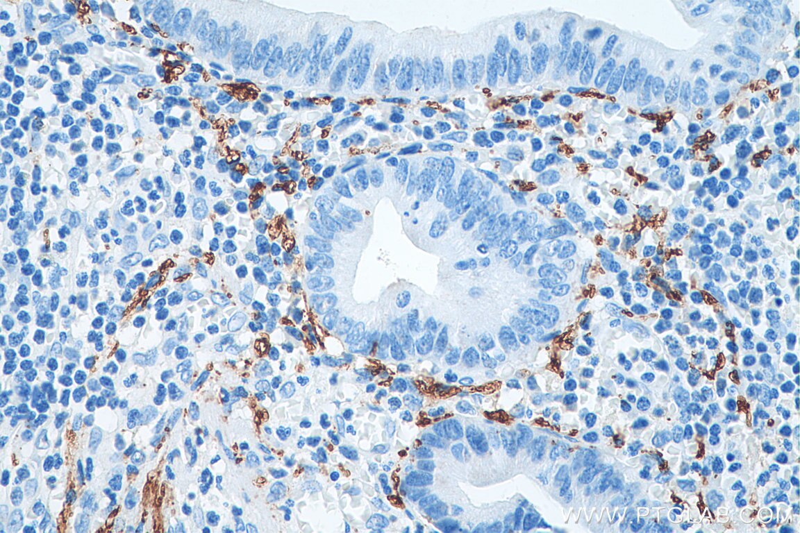 Immunohistochemistry (IHC) staining of human appendicitis tissue using Calretinin Monoclonal antibody (66496-1-Ig)