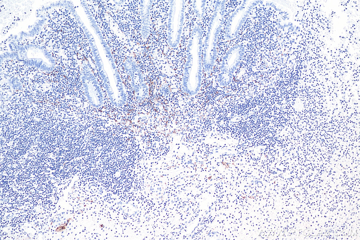 Immunohistochemistry (IHC) staining of human appendicitis tissue using Calretinin Monoclonal antibody (66496-1-Ig)