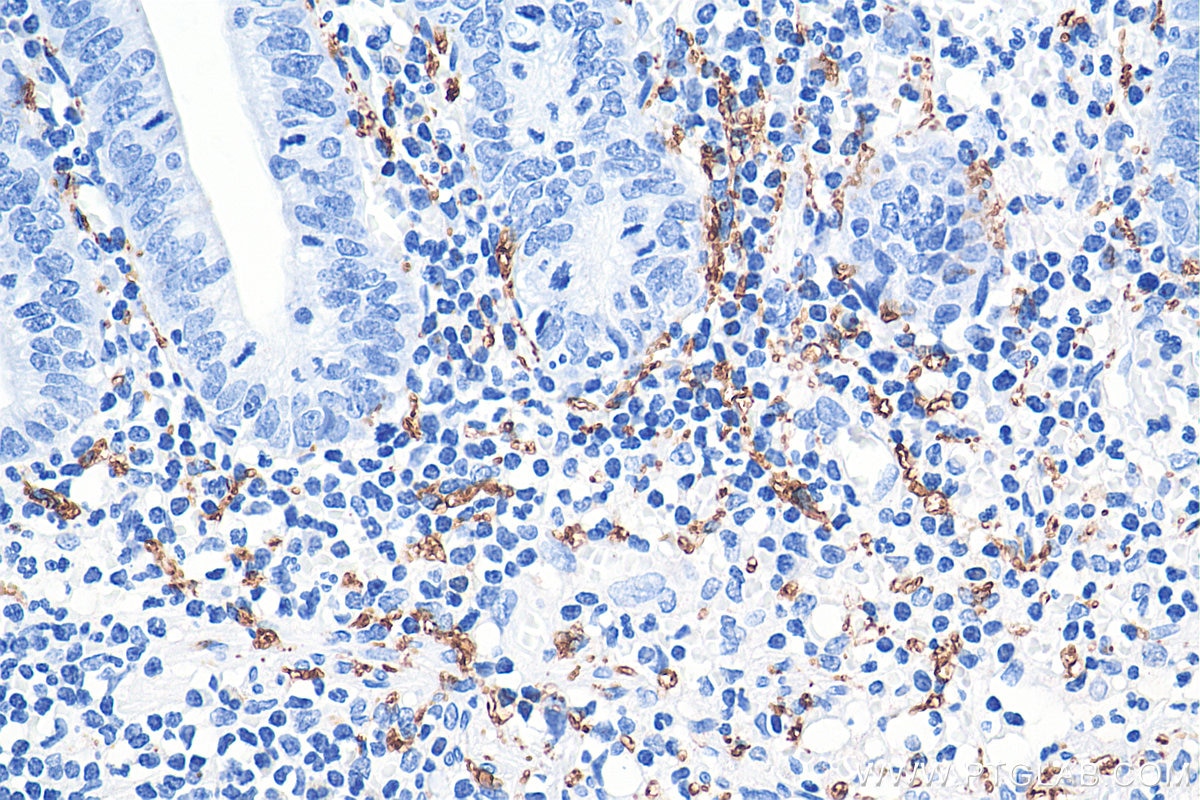 Immunohistochemistry (IHC) staining of human appendicitis tissue using Calretinin Monoclonal antibody (66496-1-Ig)