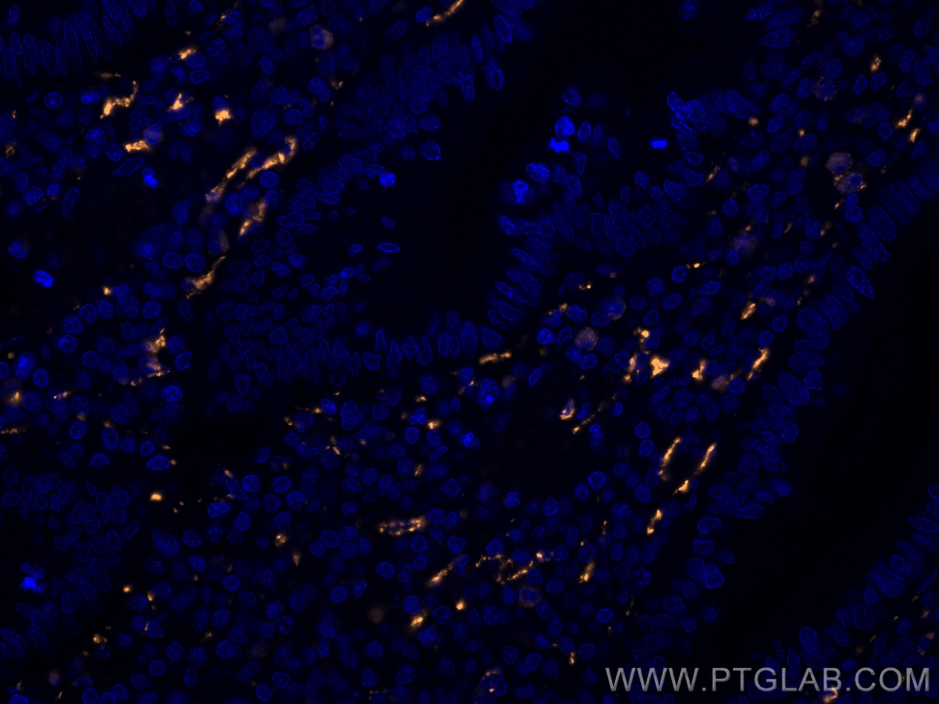 Immunofluorescence (IF) / fluorescent staining of human appendicitis tissue using CoraLite®555-conjugated Calretinin Monoclonal anti (CL555-66496)