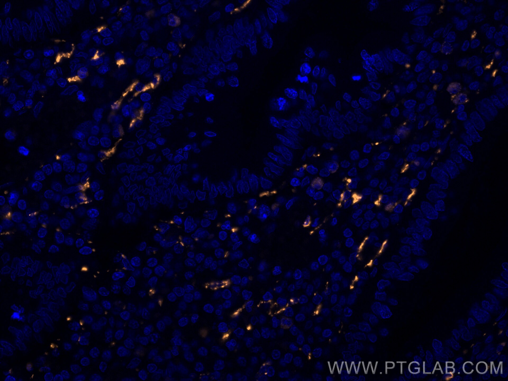 IF Staining of human appendicitis using CL555-66496