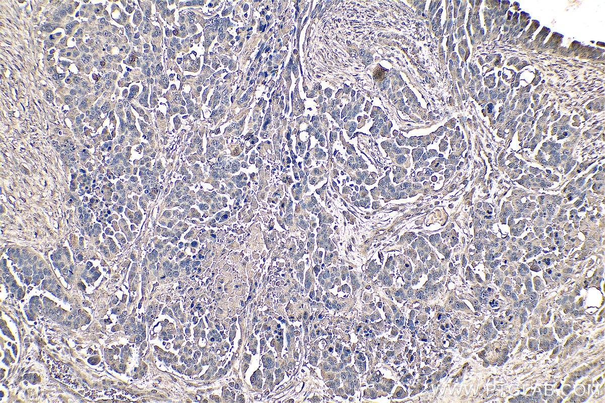 Immunohistochemistry (IHC) staining of human colon cancer tissue using Calumenin Monoclonal antibody (67585-1-Ig)