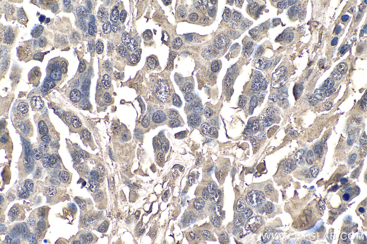 Immunohistochemistry (IHC) staining of human colon cancer tissue using Calumenin Monoclonal antibody (67585-1-Ig)
