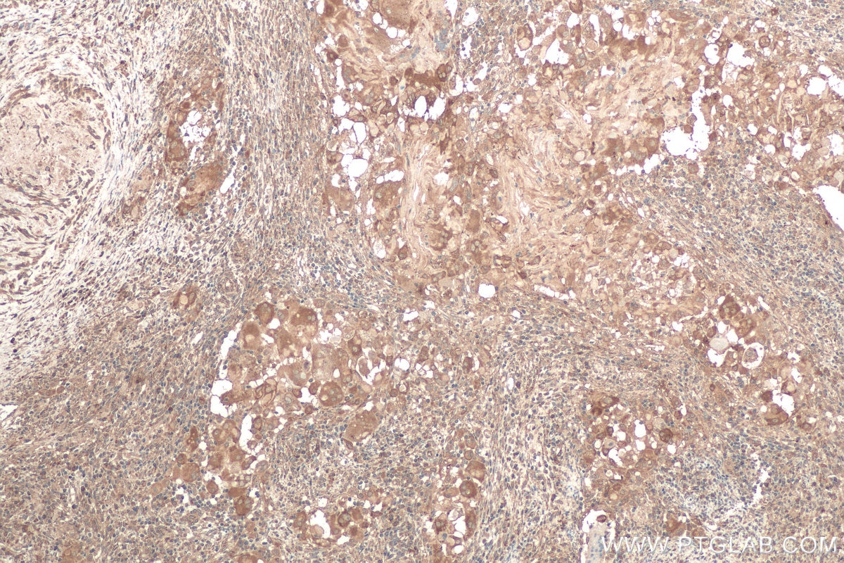 Immunohistochemistry (IHC) staining of human cervical cancer tissue using Calumenin Monoclonal antibody (67585-1-Ig)