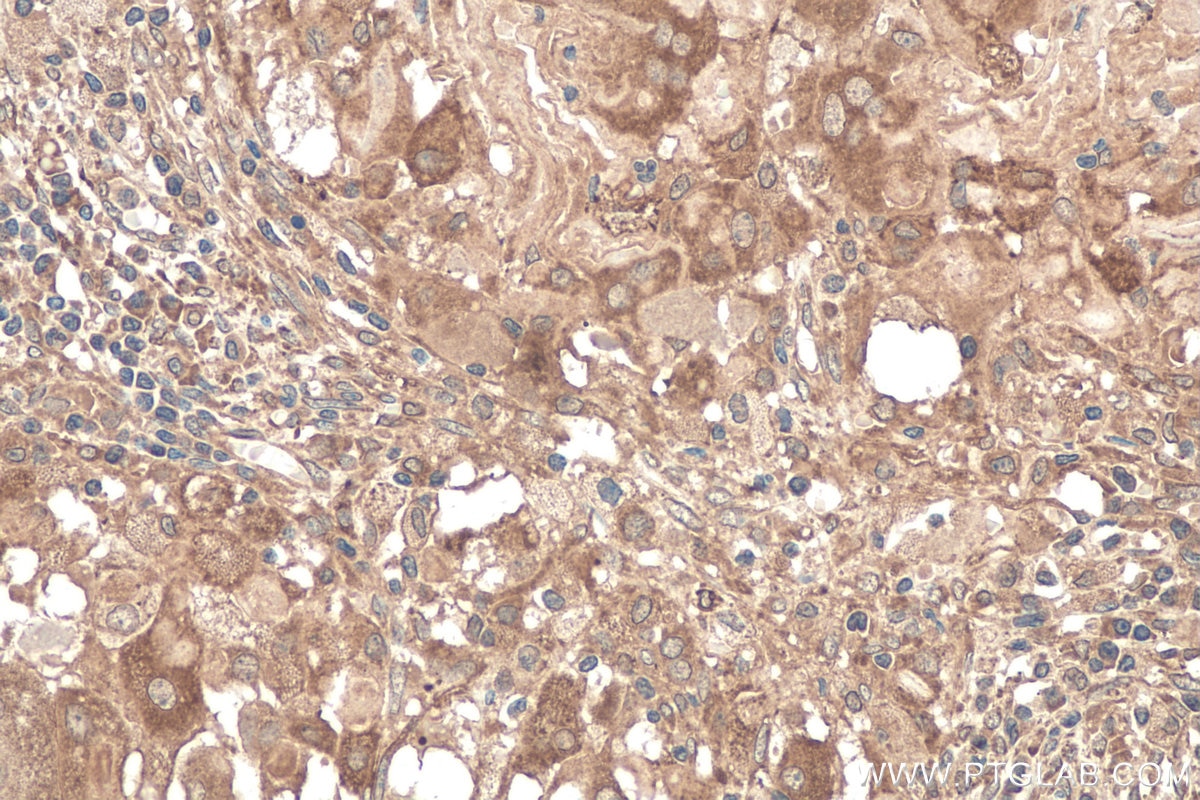 Immunohistochemistry (IHC) staining of human cervical cancer tissue using Calumenin Monoclonal antibody (67585-1-Ig)