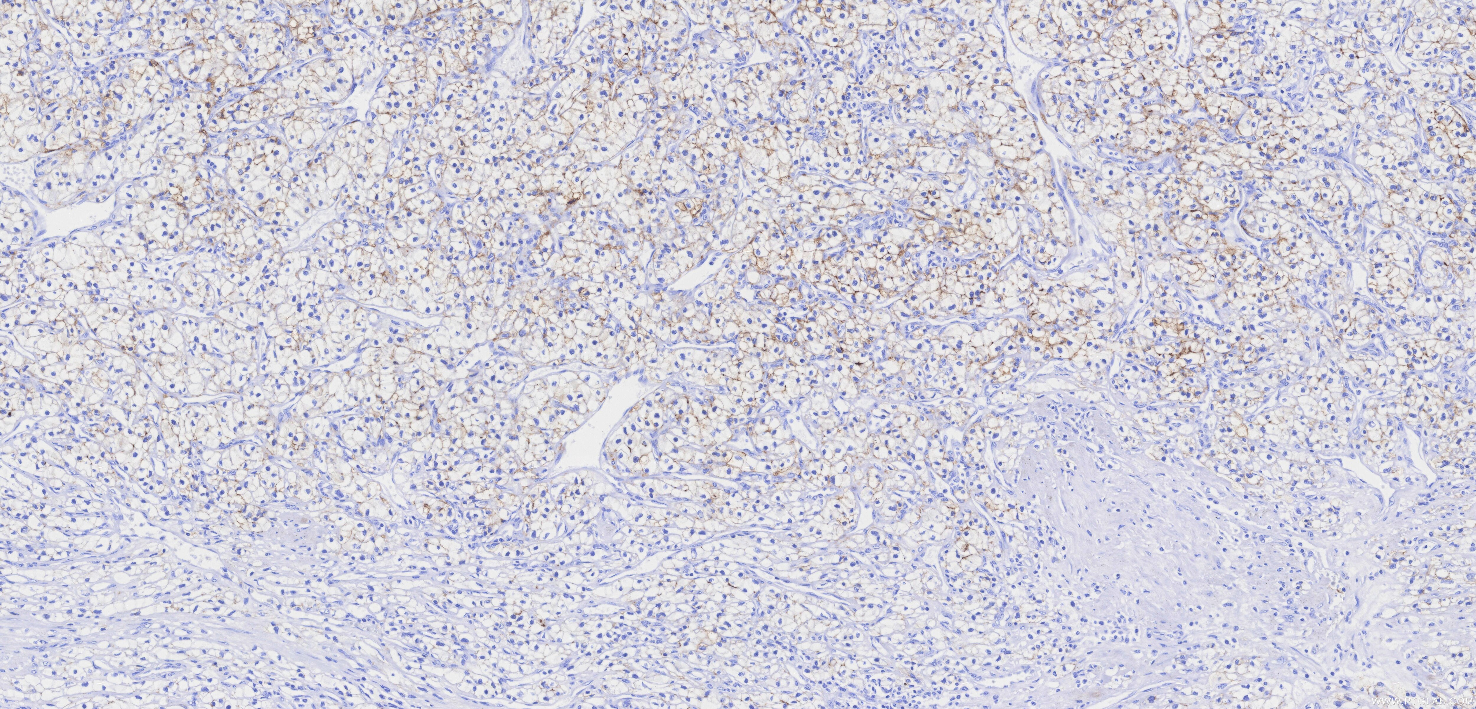 IHC staining of human renal cell carcinoma using 84233-8-RR Immunohistochemistry (IHC) staining of human renal cell carcinoma tissue using Carbonic Anhydrase IX/CA9 Recombinant monoclonal a (84233-8-RR)
