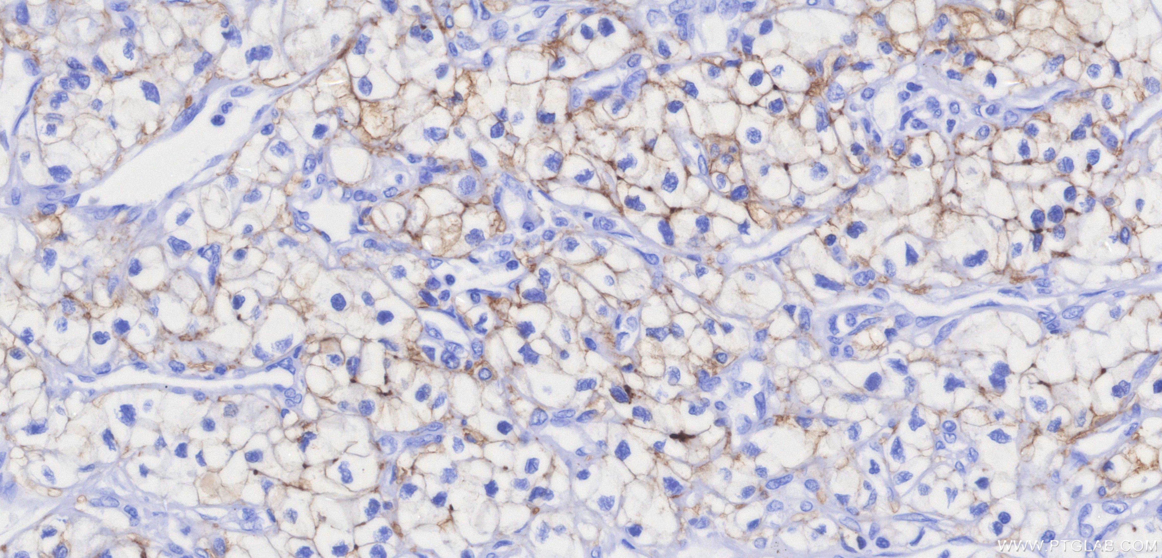 IHC staining of human renal cell carcinoma using 84233-8-RR Immunohistochemistry (IHC) staining of human renal cell carcinoma tissue using Carbonic Anhydrase IX/CA9 Recombinant monoclonal a (84233-8-RR)