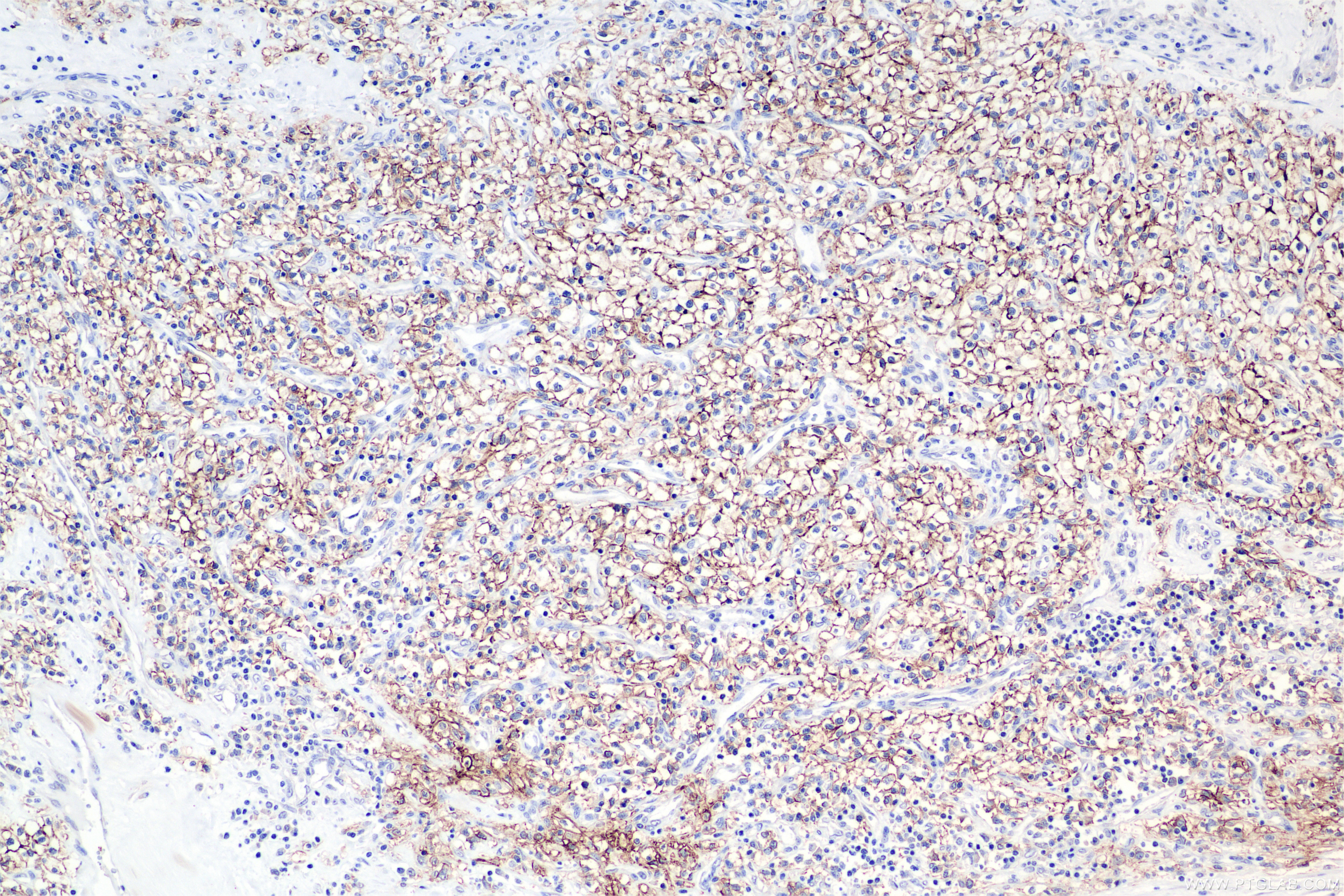 IHC staining of human kidney(renal cell) cancer using 84233-8-RR Immunohistochemistry (IHC) staining of human kidney(renal cell) cancer using Carbonic Anhydrase IX/CA9 Recombinant monoclonal a (84233-8-RR)