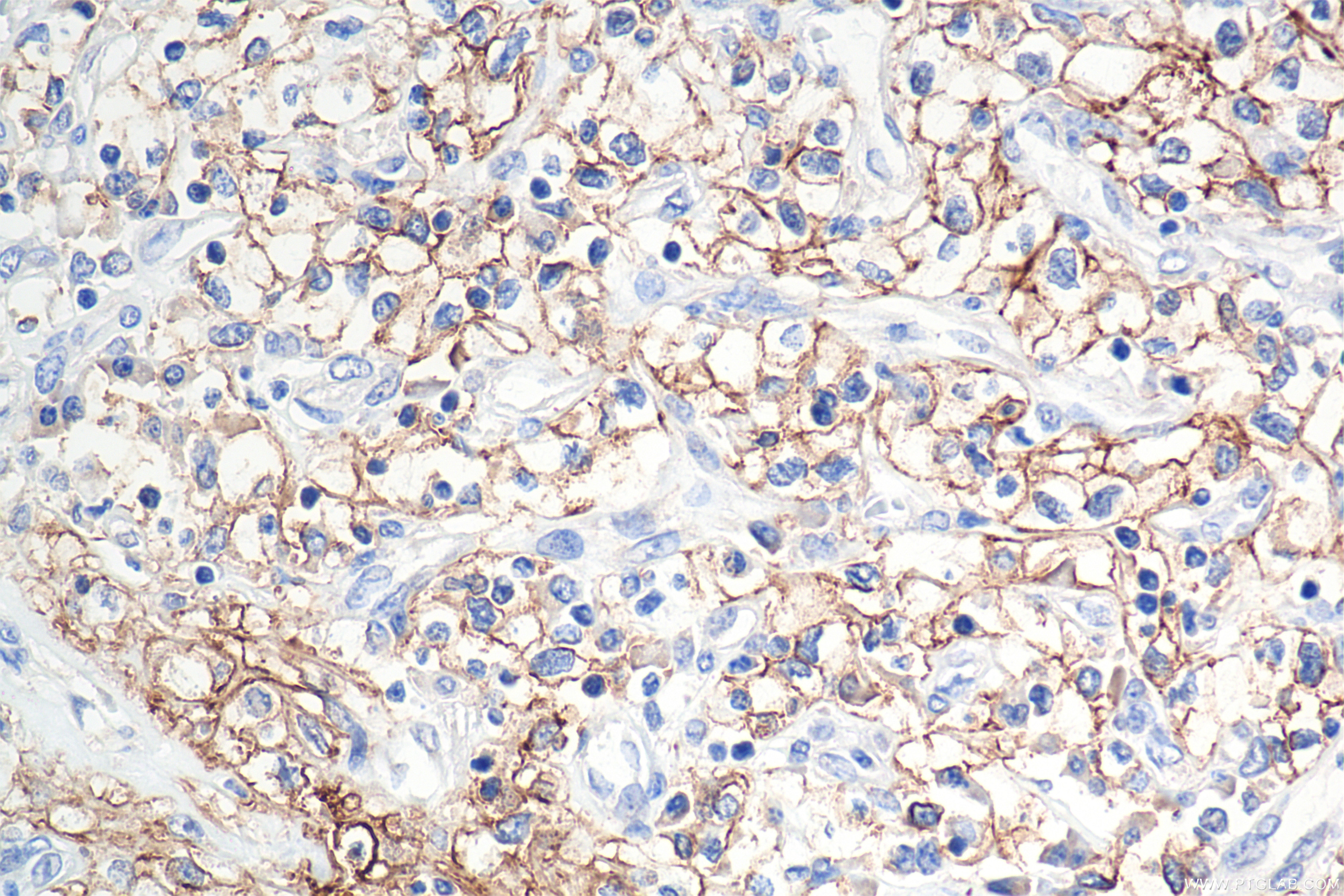 IHC staining of human kidney(renal cell) cancer using 84233-8-RR Immunohistochemistry (IHC) staining of human kidney(renal cell) cancer using Carbonic Anhydrase IX/CA9 Recombinant monoclonal a (84233-8-RR)