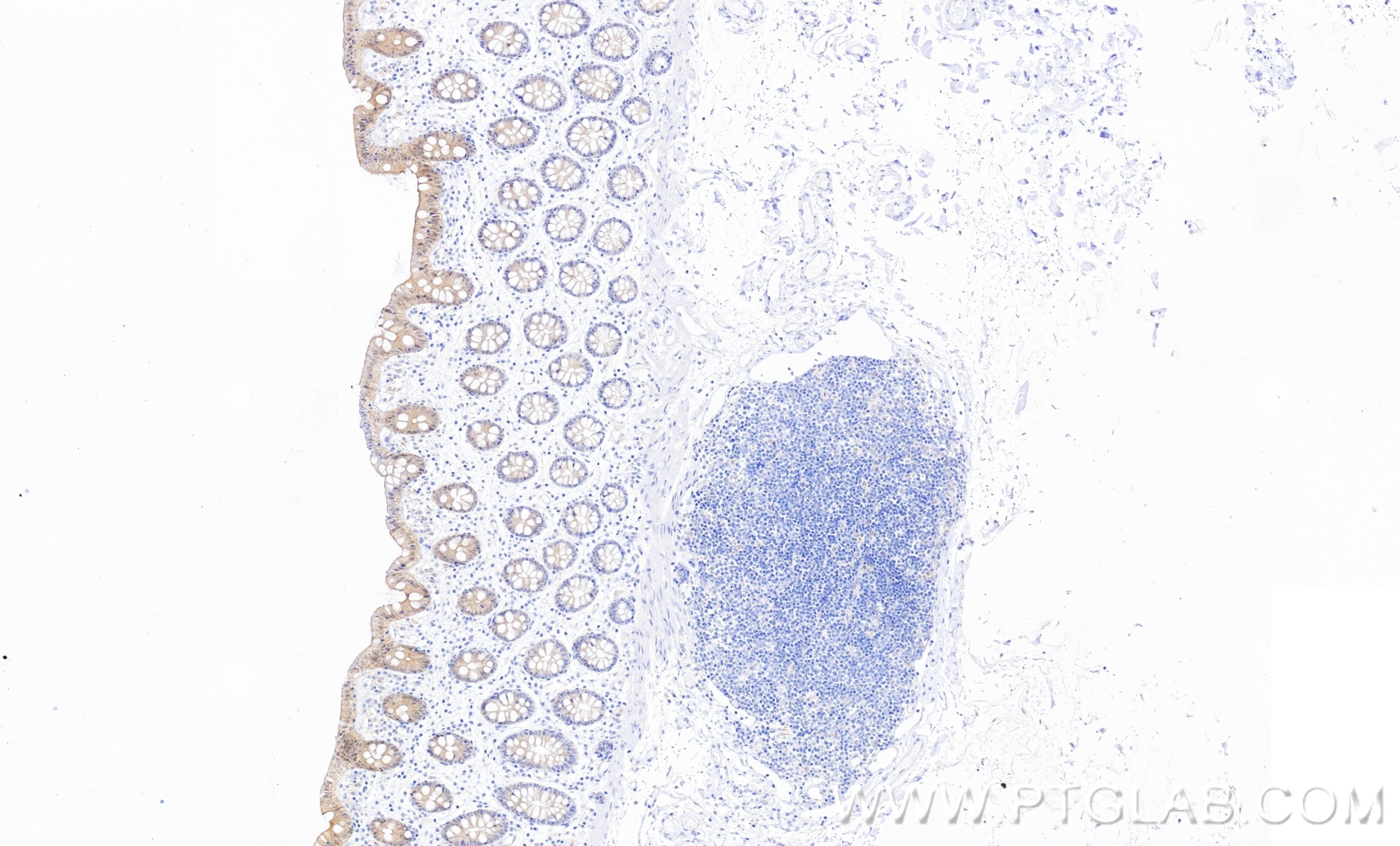 Immunohistochemistry (IHC) staining of human colon tissue using Casein Kinase 1 Delta Recombinant monoclonal antib (86423-2-RR)