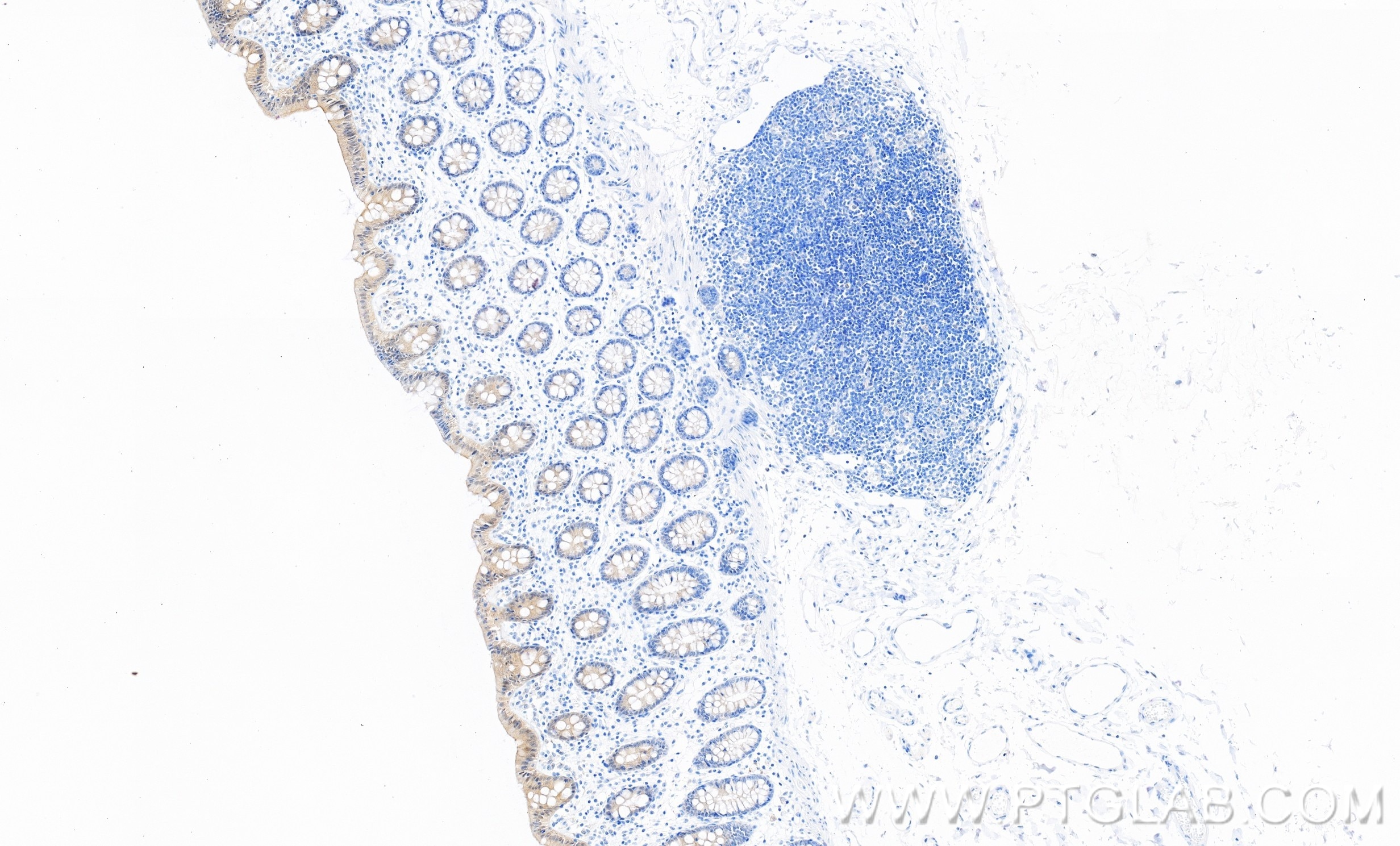 Immunohistochemistry (IHC) staining of human colon tissue using Casein Kinase 1 Delta Recombinant monoclonal antib (86423-2-RR)