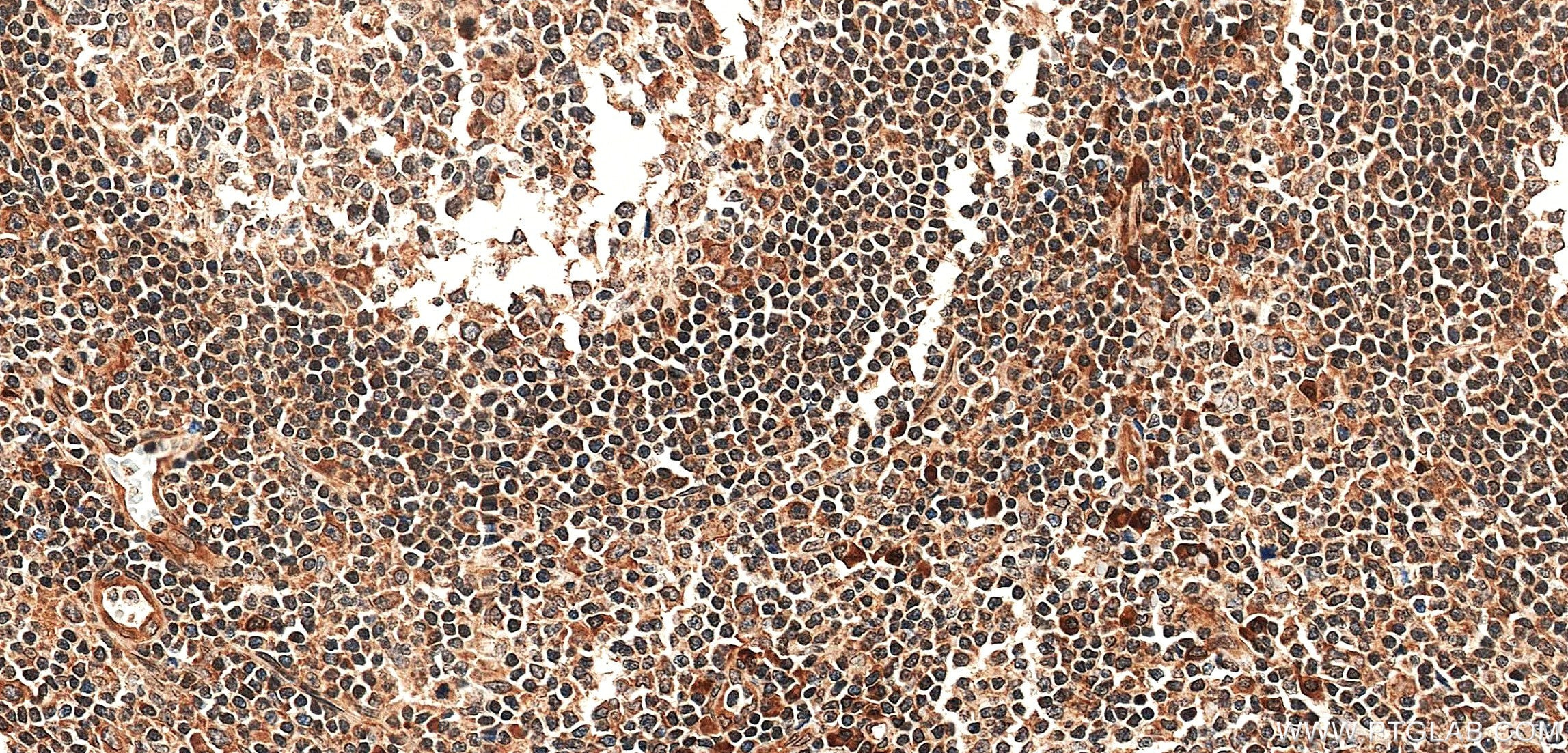 IHC staining of human tonsil using 85196-3-RR Immunohistochemistry (IHC) staining of human tonsil tissue using Caspase 10 Recombinant monoclonal antibody (85196-3-RR)