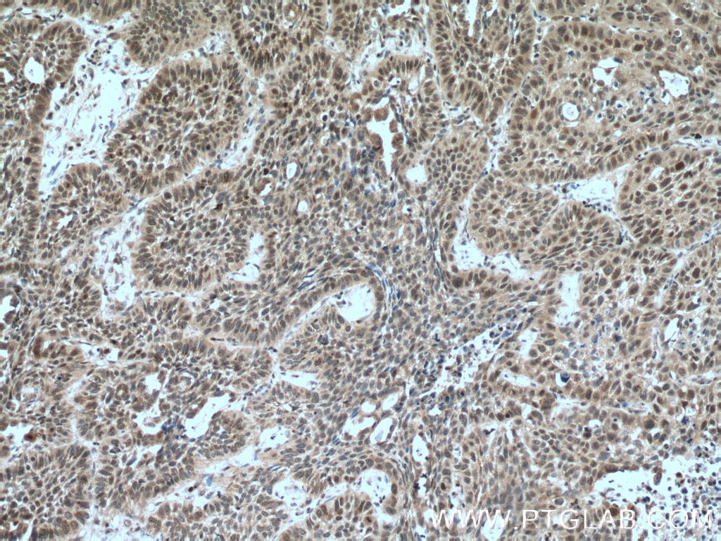 Immunohistochemistry (IHC) staining of human lung cancer tissue using Caspase 2/p18 Polyclonal antibody (24777-1-AP)