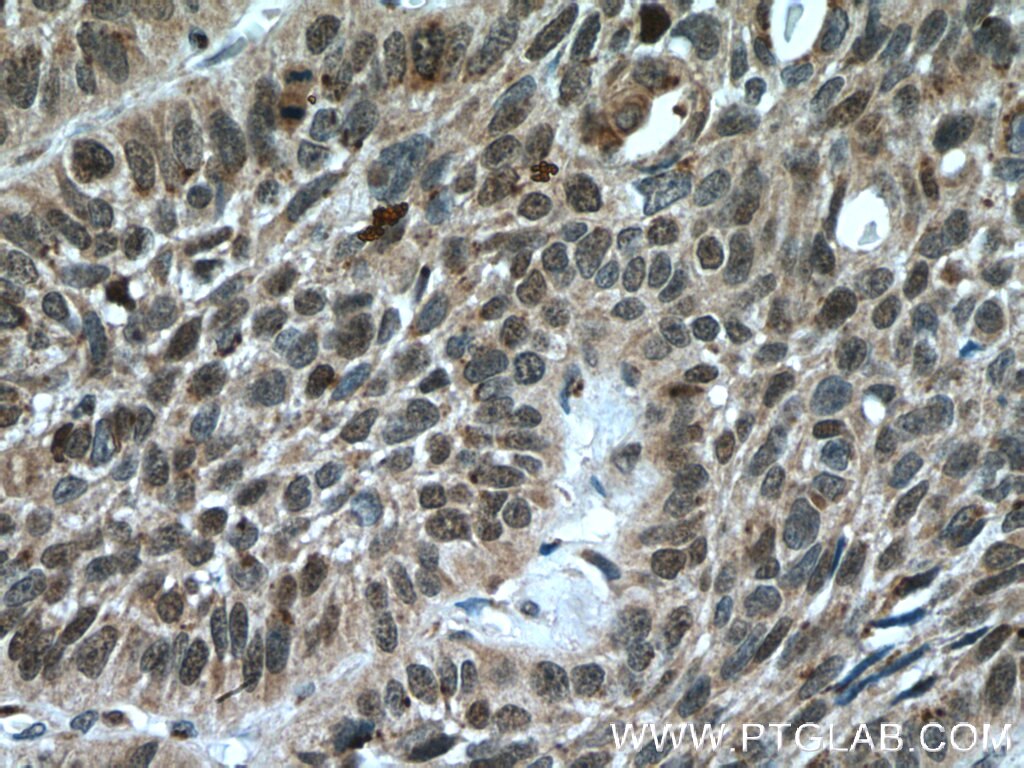 Immunohistochemistry (IHC) staining of human lung cancer tissue using Caspase 2/p18 Polyclonal antibody (24777-1-AP)