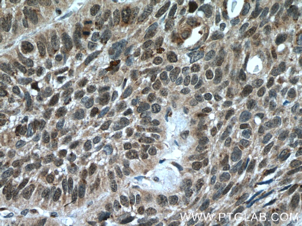 IHC staining of human lung cancer using 24777-1-AP