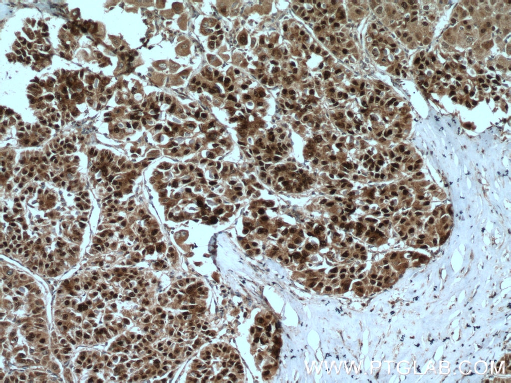 Immunohistochemistry (IHC) staining of human liver cancer tissue using Caspase 2/p18 Polyclonal antibody (24777-1-AP)