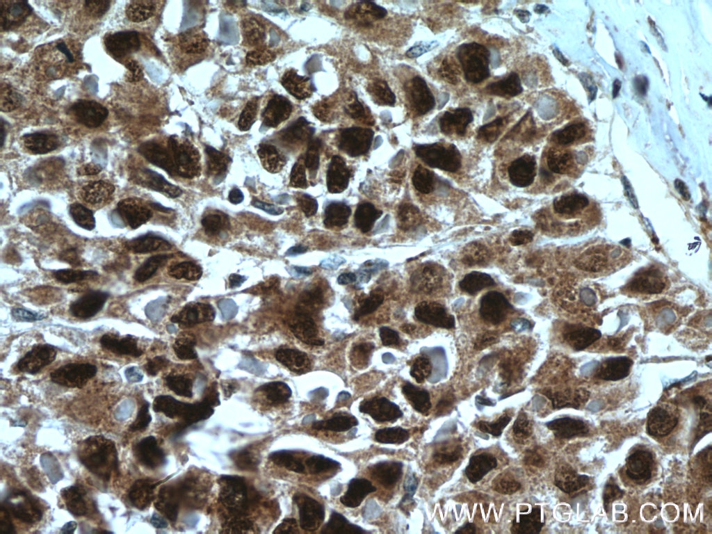Immunohistochemistry (IHC) staining of human liver cancer tissue using Caspase 2/p18 Polyclonal antibody (24777-1-AP)